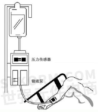 【应用】小型压力传感器sm5g,sm4x21在医用输液泵中的